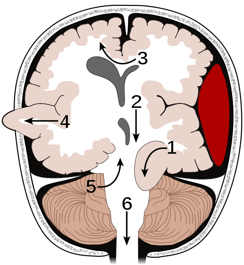 Mozkové herniace