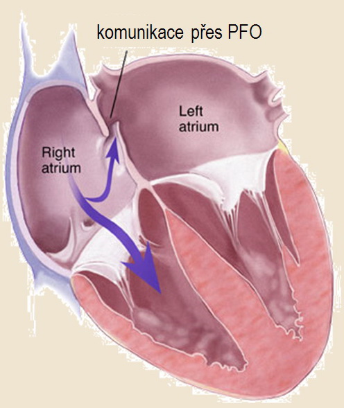 Foramen ovale patens