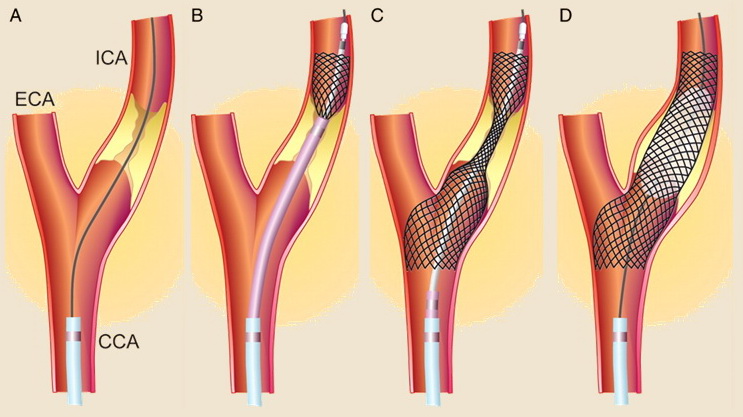 Samoexpandibilní stent