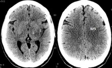 ASPECTS 7 - hypodenzita v nucl. lentiformis, inzule a M5