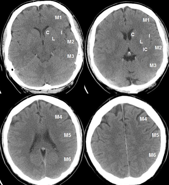 aspect-score-stroke-manual