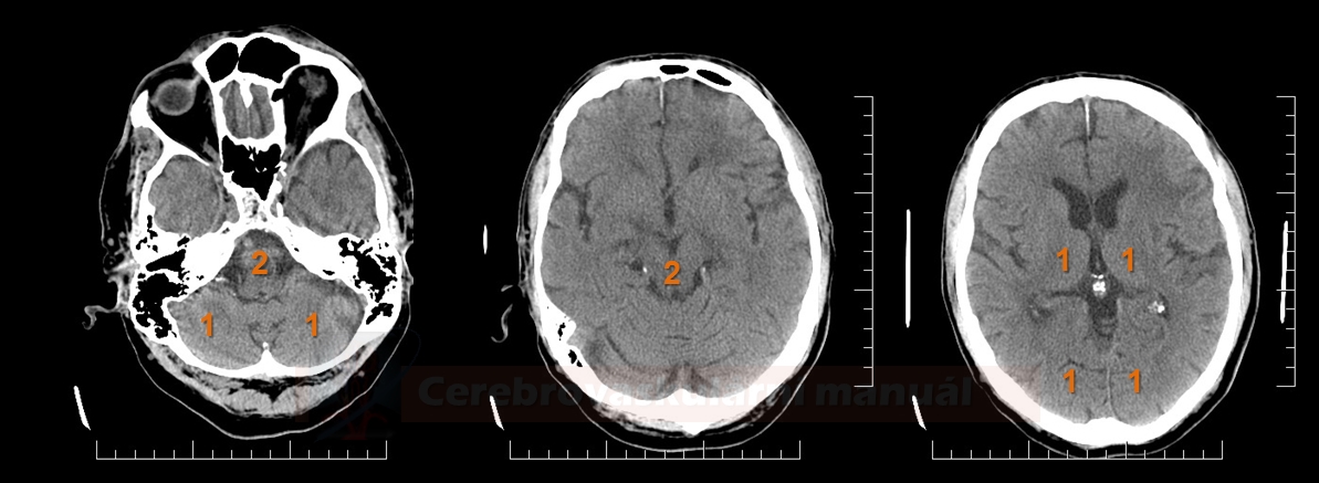 9-11-aspects-score-diagnostick-a-terapeutick-manu-l-c-vn-ch