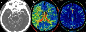 Chronická, kompenzovaná okluze ACM s dobrým kolaterálním oběhem. A – CT angiografie s nálezem okluze M1 úseku ACM , B – prodloužené MTT v povodí ACM vpravo, C -normální CBV