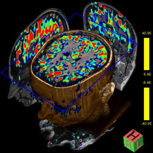 MR Arterial Spin Labeling (ASL)
